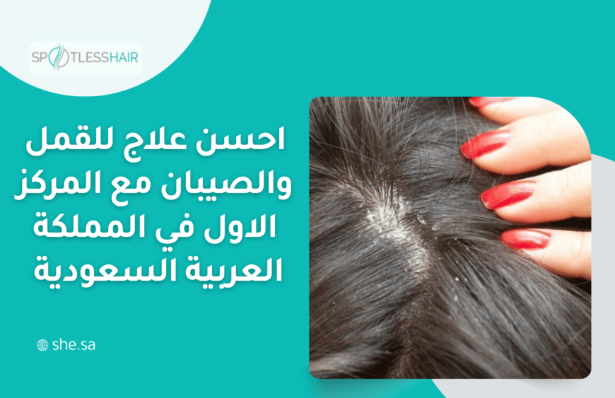 احسن علاج للقمل والصيبان