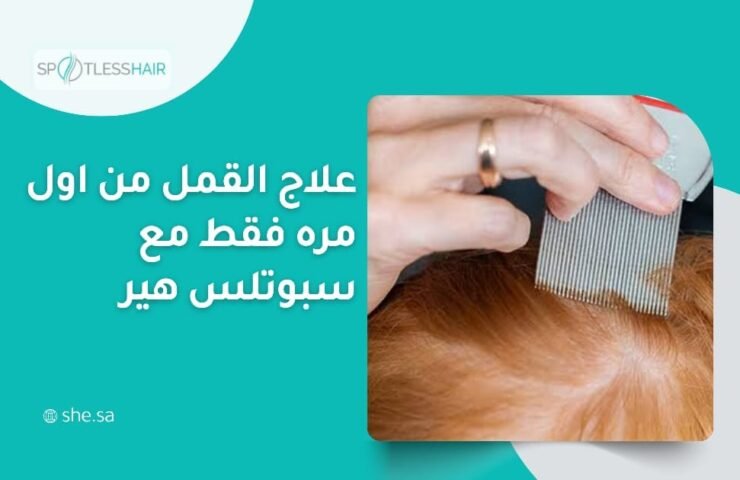 علاج القمل من اول مره