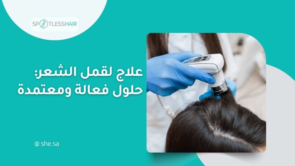 علاج لقمل الشعر