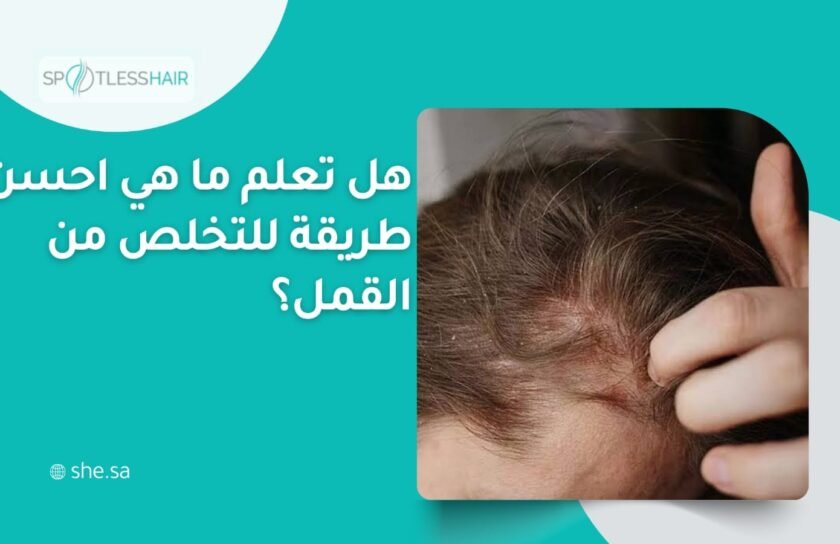 احسن طريقة للتخلص من القمل