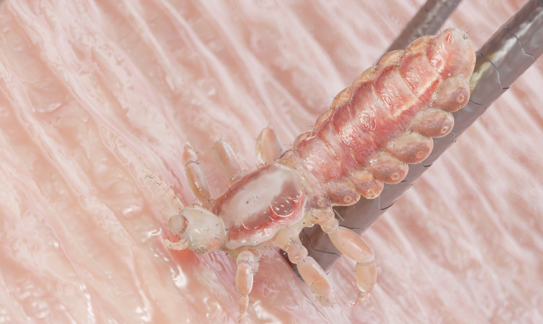 قملة رأس تتغذى على الدم من فروة الرأس دون نقل أي أمراض أو عدوى.