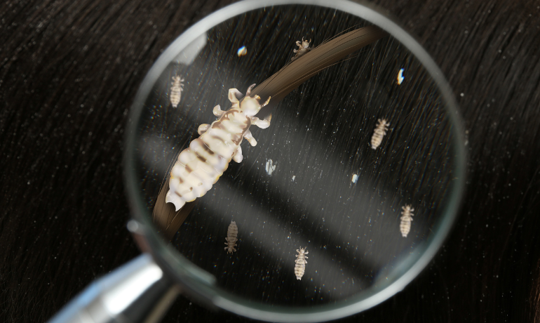 قملة وبيض قمل تحت عدسة مكبرة توضح أعراض القمل في الشعر و دلائل وجود القمل
