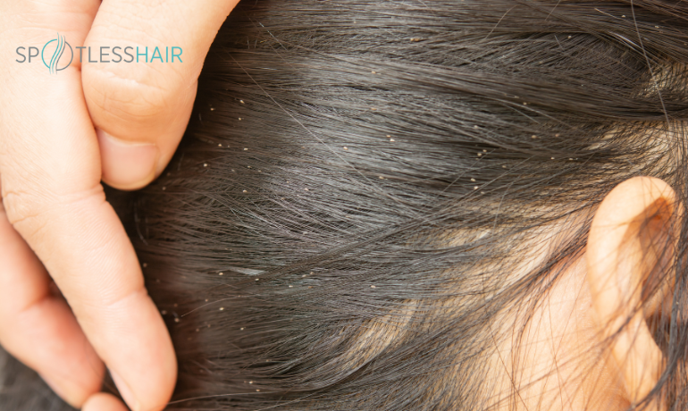 صورة الصيبان الملتصق بالشعر توضح أسباب ظهور القمل في فروة الرأس