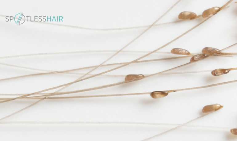 كيف أعرف أن بيض القمل ميت؟ وماهو شكل الصيبان في الشعر