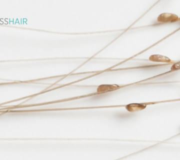 كيف أعرف أن بيض القمل ميت؟ وماهو شكل الصيبان في الشعر