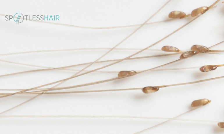 كيف أعرف أن بيض القمل ميت؟ وماهو شكل الصيبان في الشعر