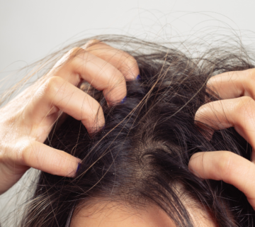 شخص يخدش فروة رأسه بسبب الحكة الناتجة عن القمل أو القشرة أو جفاف فروة الرأس.