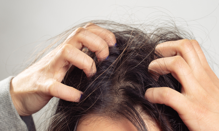 شخص يخدش فروة رأسه بسبب الحكة الناتجة عن القمل أو القشرة أو جفاف فروة الرأس.