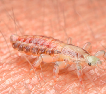 أسباب ظهور القمل بالشعر والعوامل التي تزيد انتقال القمل بين الأشخاص