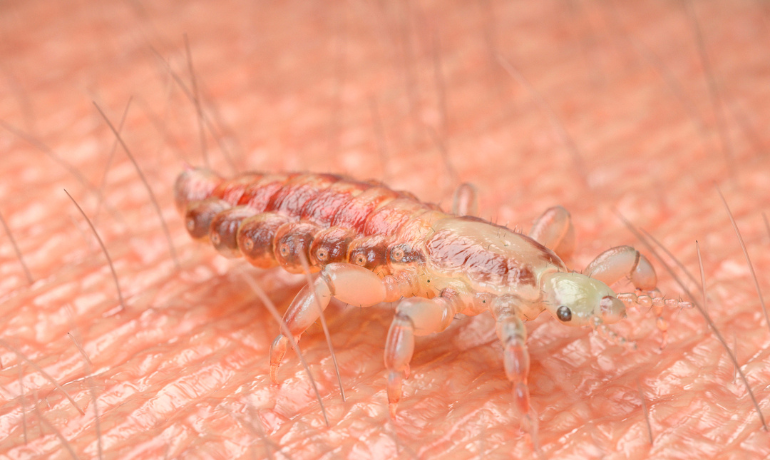 أسباب ظهور القمل بالشعر والعوامل التي تزيد انتقال القمل بين الأشخاص