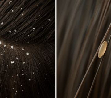 الفرق بين القشرة والقمل في الشعر: قشرة رأس خفيفة مقابل بيض القمل الملتصق بالشعرة