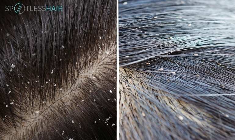 The difference between nits and dandruff