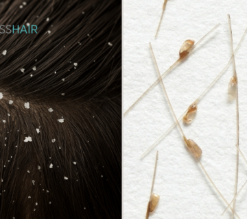 The difference between dandruff and nits: What are the causes and treatment of itchy scalp?
