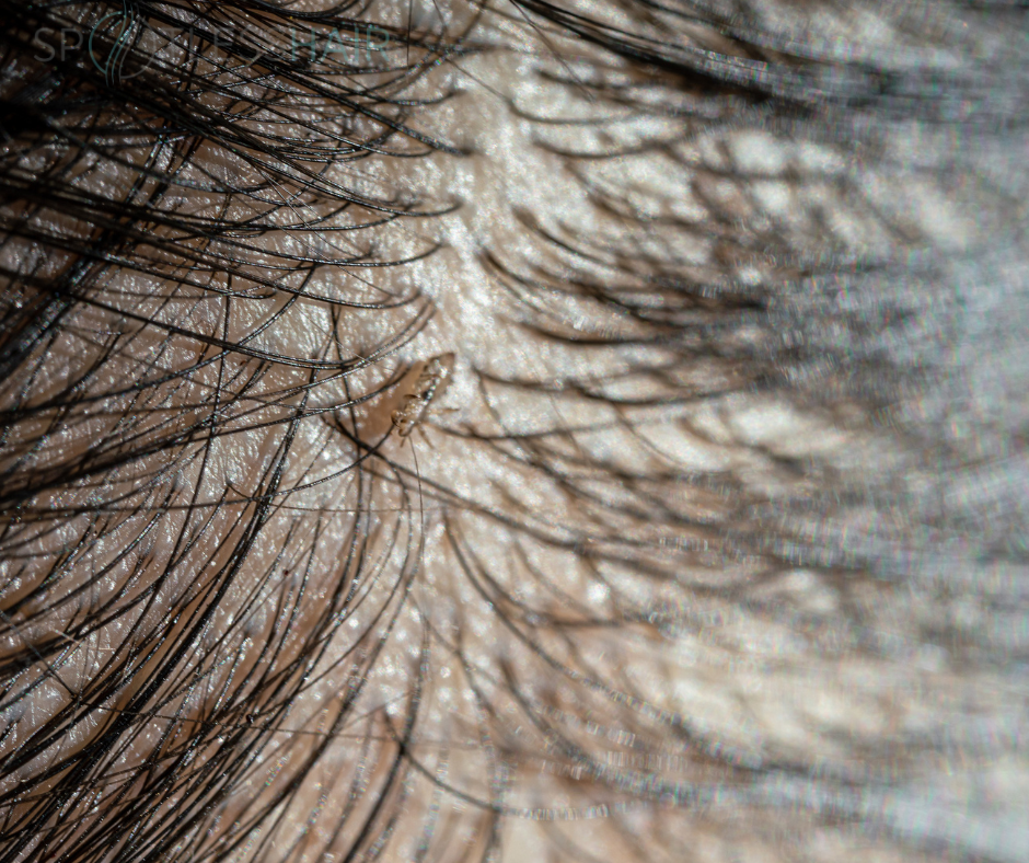 شكل القمل في الشعر