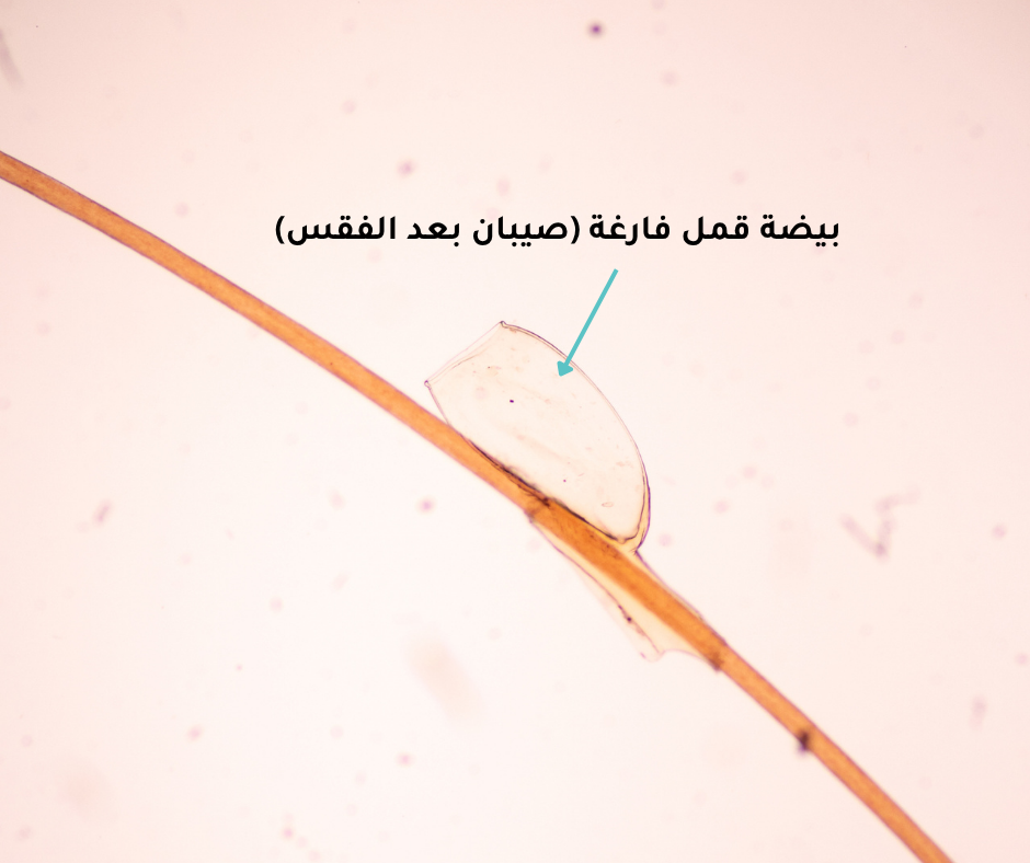 شكل الصيبان الميت