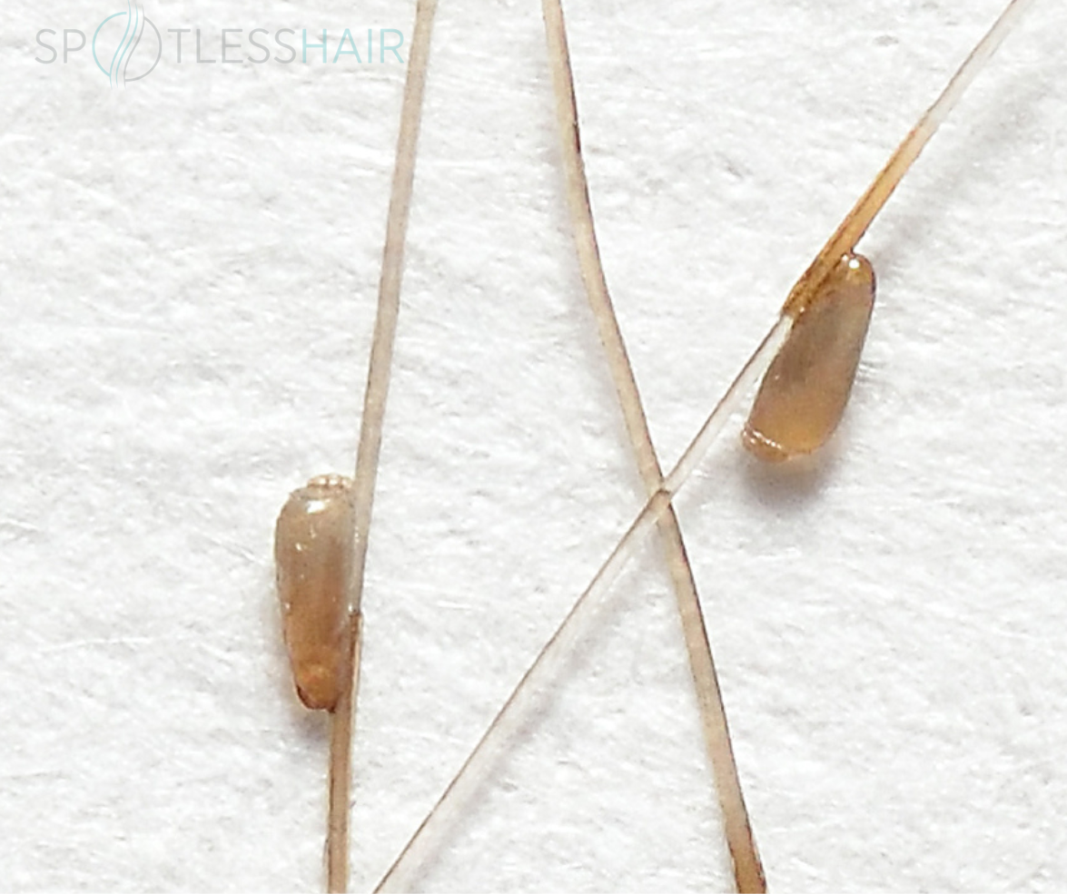 شكل بيض القمل الحي