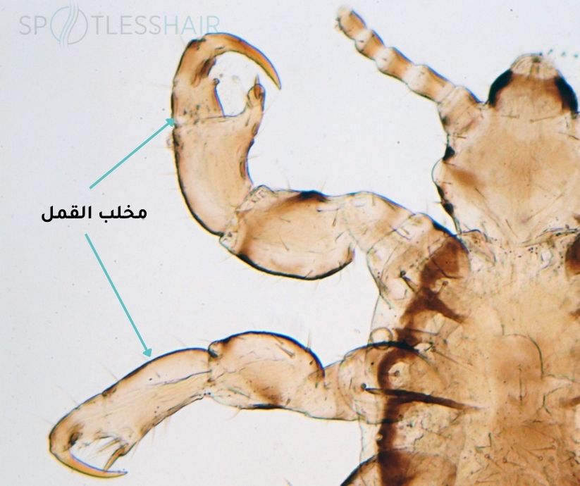 كيف ينتقل القمل بالصور