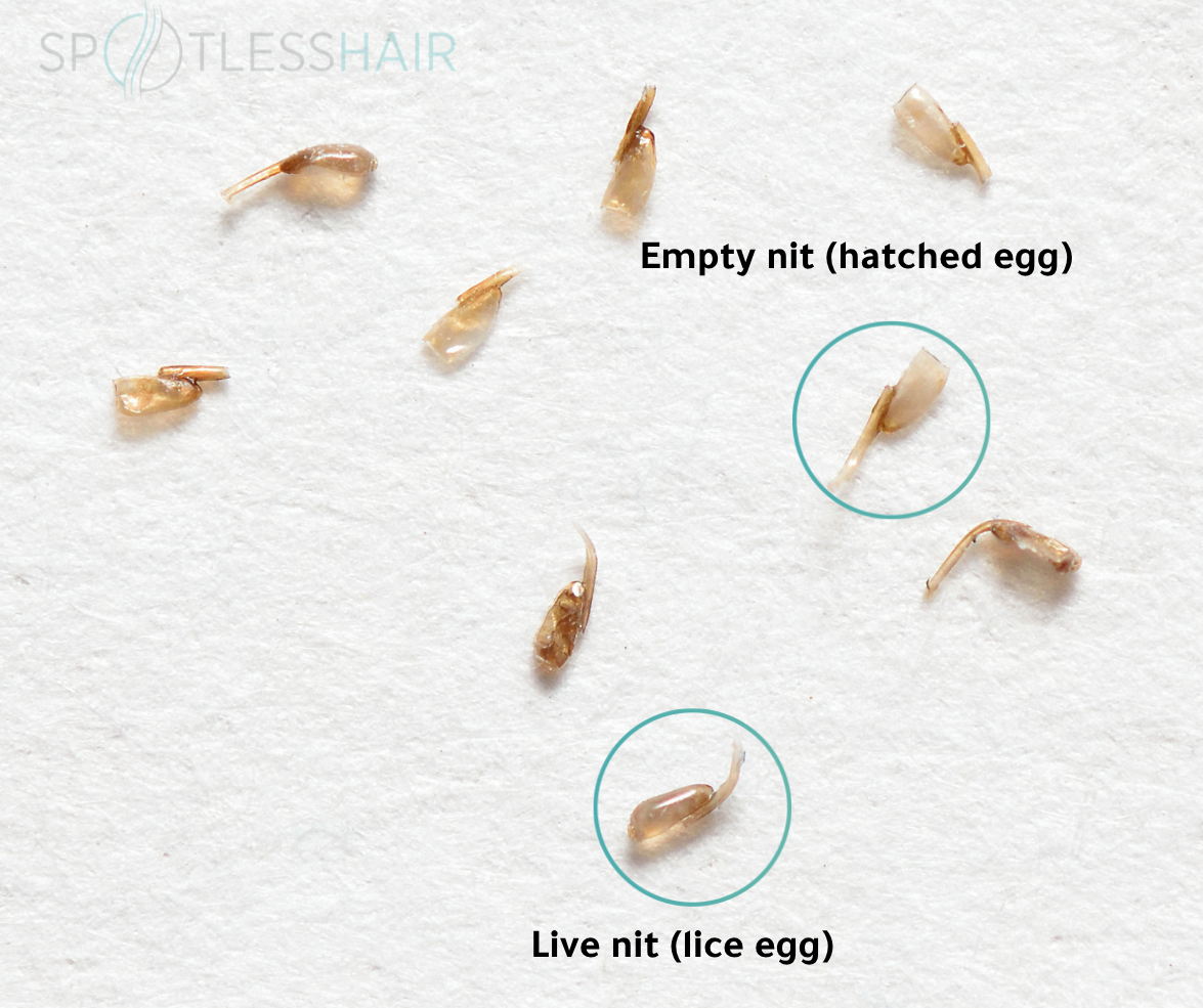 Live vs Dead Nits (After Hatching)