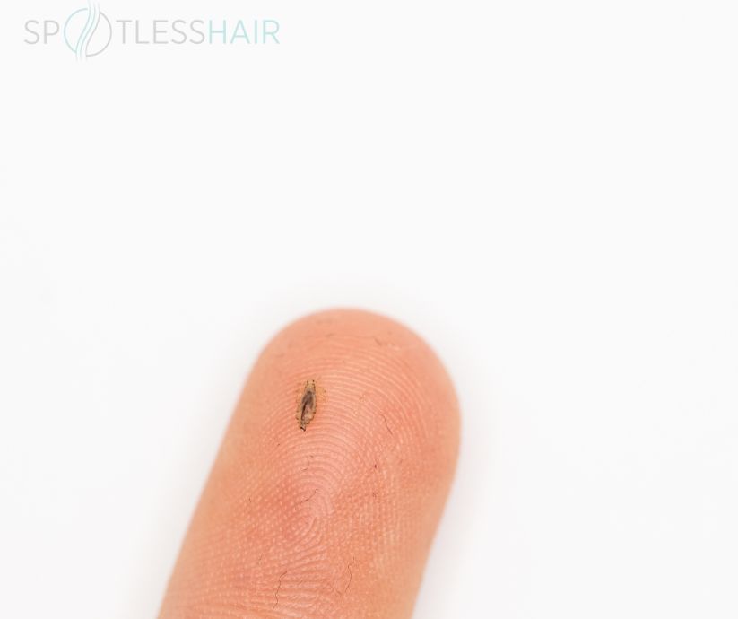 حجم القملة مع اليد بالصور
